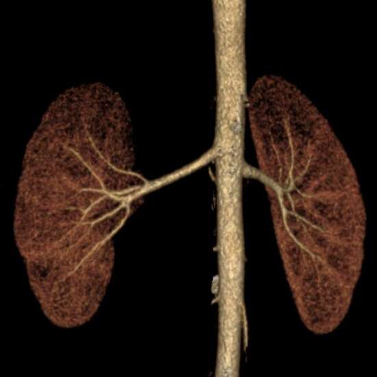 CT Renal Angiography